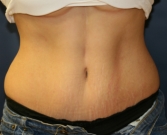 Feel Beautiful - Tummy Tuck Case 16 - After Photo